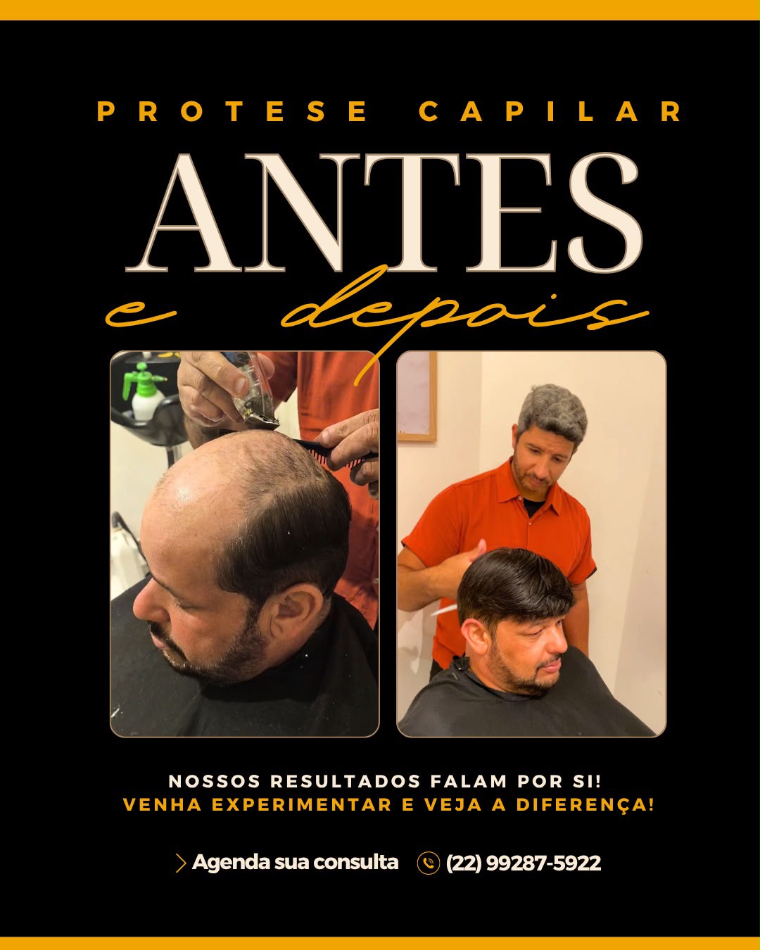 Antes e depois de prótese capilar — resultado 5