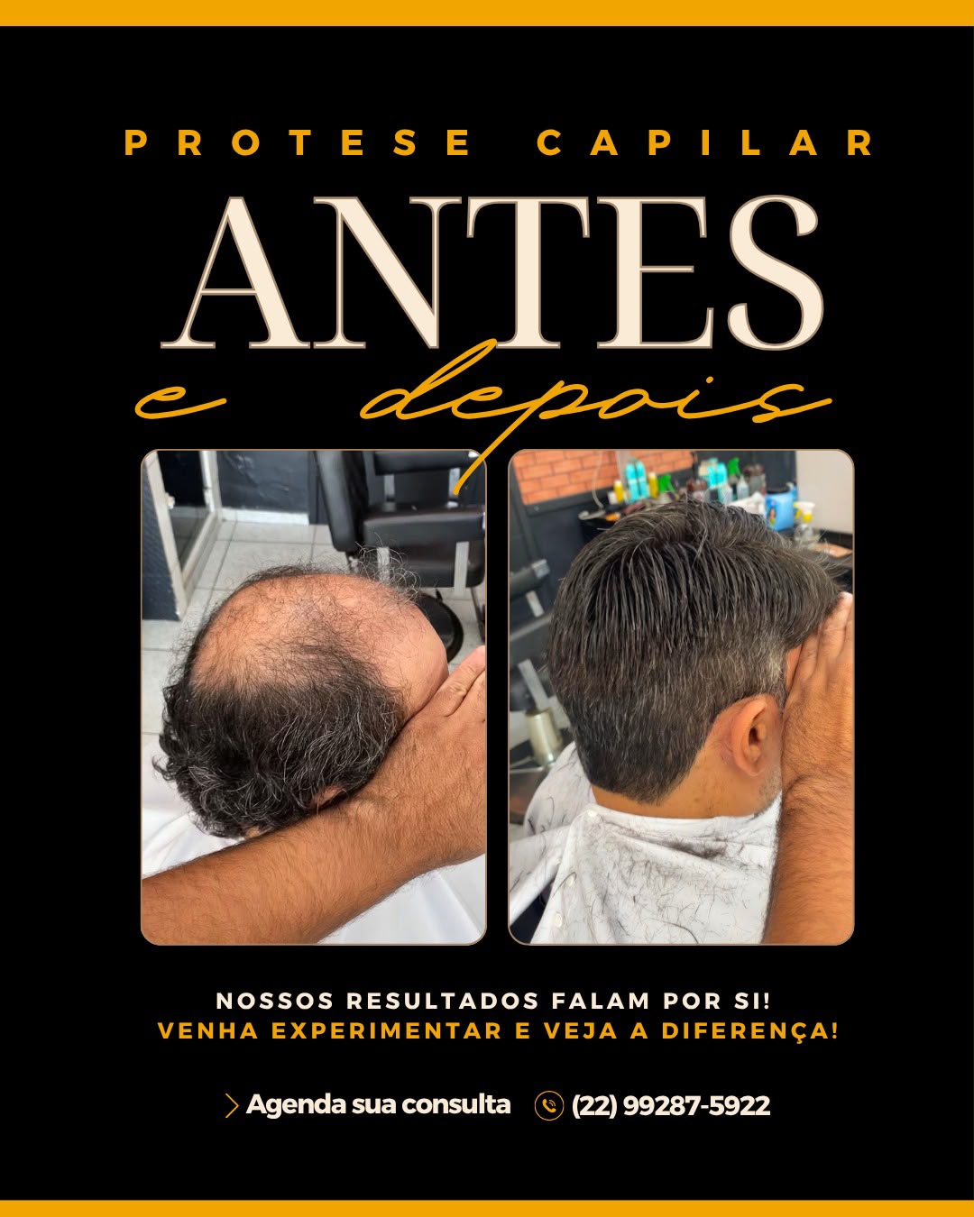 Detalhes de um resultado natural de prótese capilar