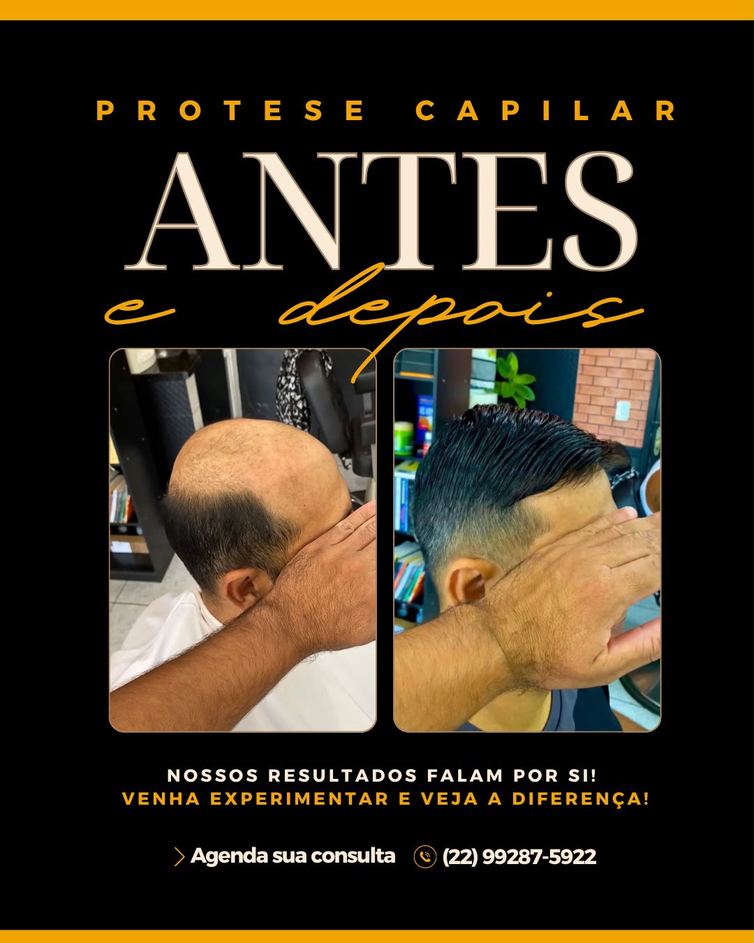 Antes e depois de prótese capilar — resultado 4