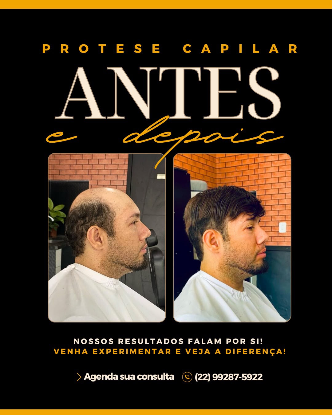 Antes e depois de prótese capilar — resultado 6