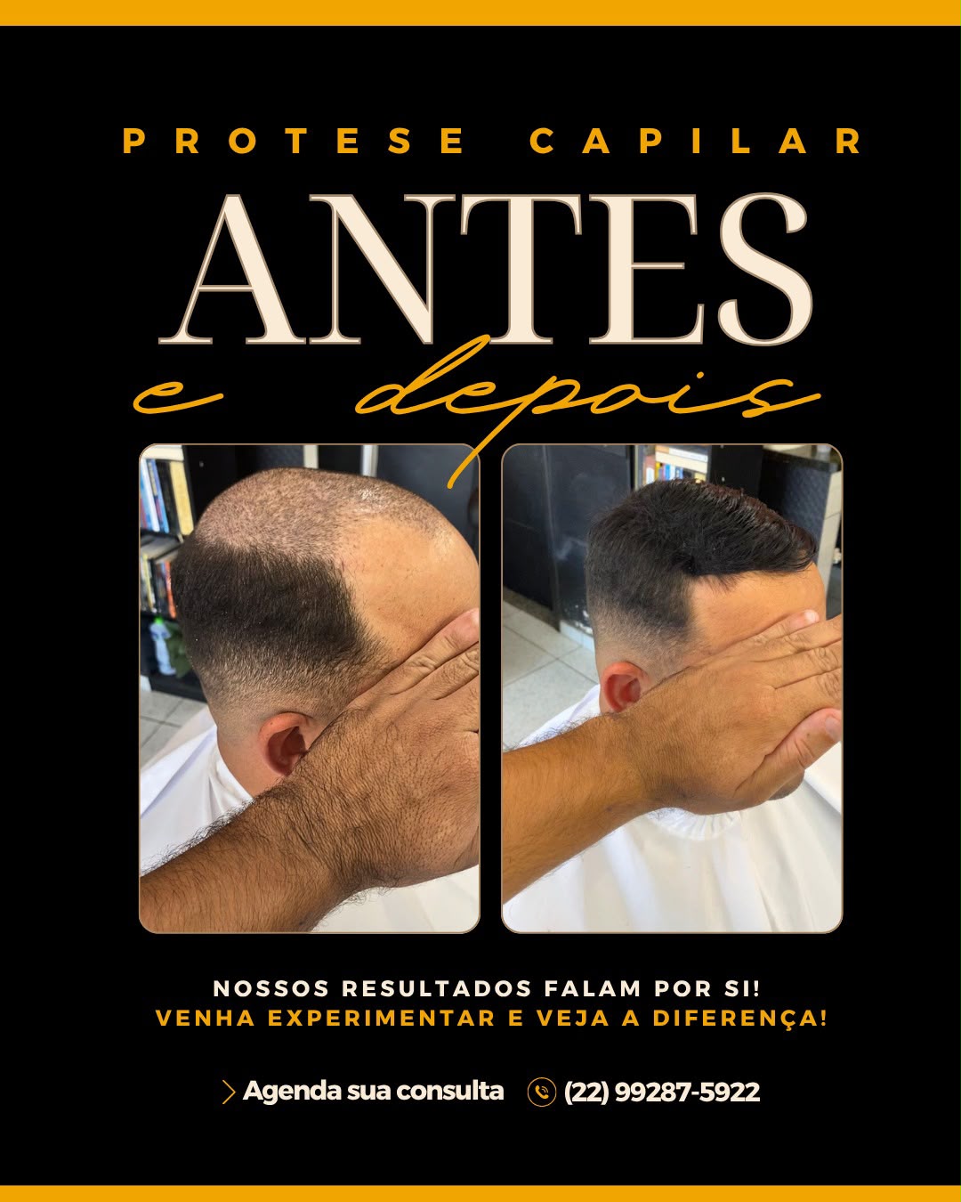 Antes e depois de prótese capilar — resultado 3