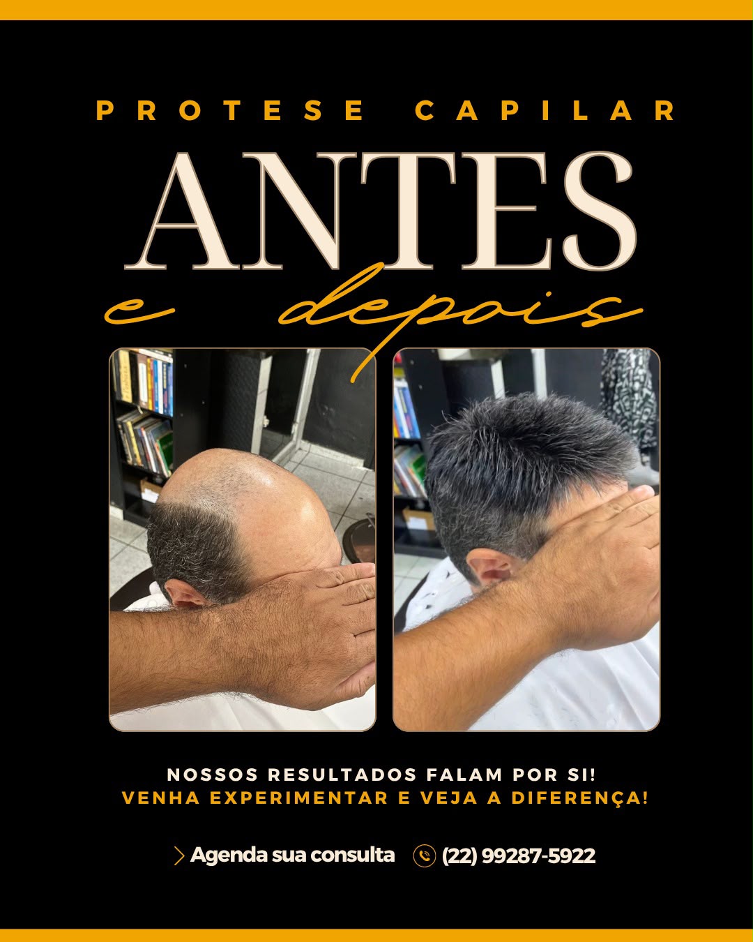 Antes e depois de prótese capilar — resultado 2