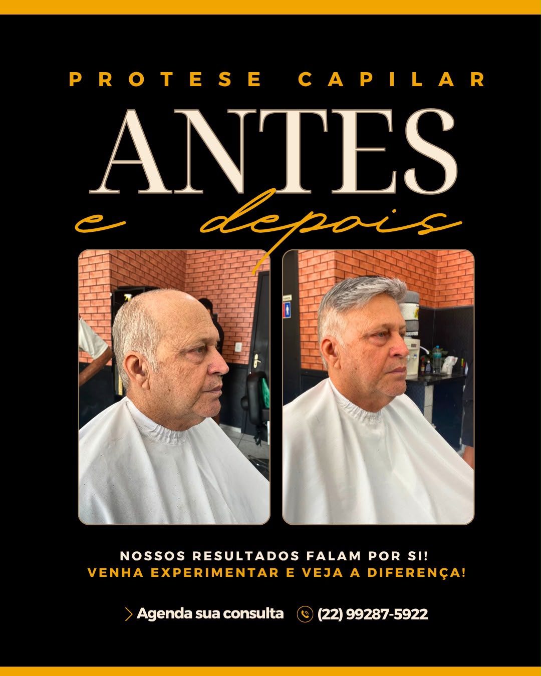 Antes e depois de prótese capilar — resultado 1